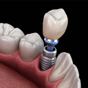 Dental implant in Louisville, KY receiving restoration