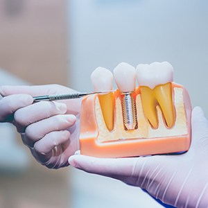 Model showing jawbone density for dental implants in Louisville 