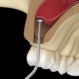 Digital illustration of a sinus lift for dental implants in Louisville 
