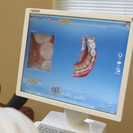CEREC dental implant abutment and dental crown design on computer screen