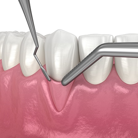 Animated smile during gum grafting treatment