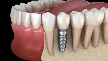 Animated smile with dental implant supported dental crown replacement tooth