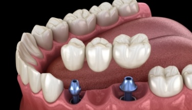 Animated dental implant supported fixed bridge placement