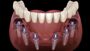 Animated dental implant supported fixed bridge placement