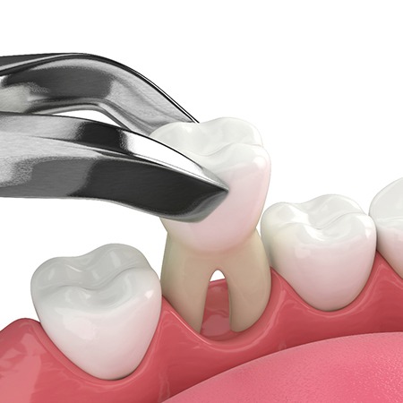 Illustration of a tooth extraction