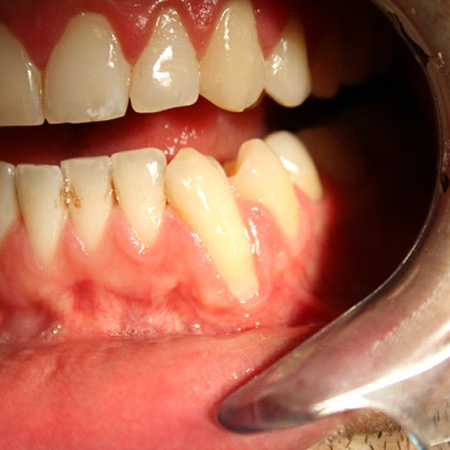 Closeup of a mouth in need of gum grafting in Louisville