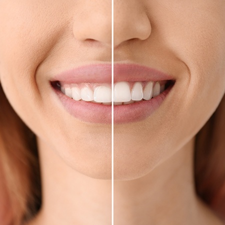 A woman’s newly improved smile after gum recontouring