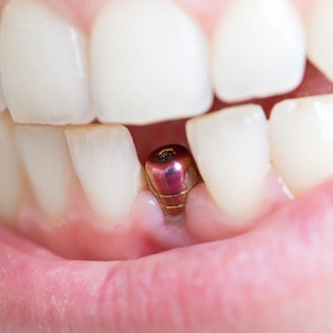 Dental implant in Louisville