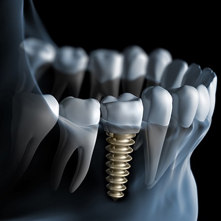 Render showing dental implant in Louisville, KY in lower jaw