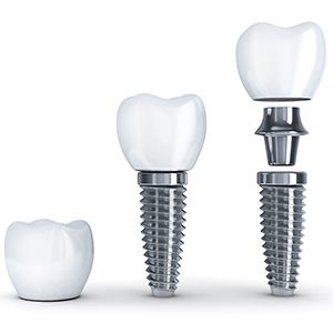 Crown, abutment, and post of dental implant in Louisville, KY