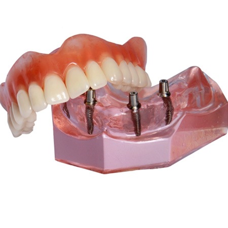 Set of implant dentures and model jaw with abutments