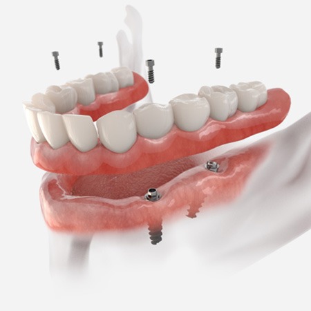 CGI showing how implant dentures are permanently affixed