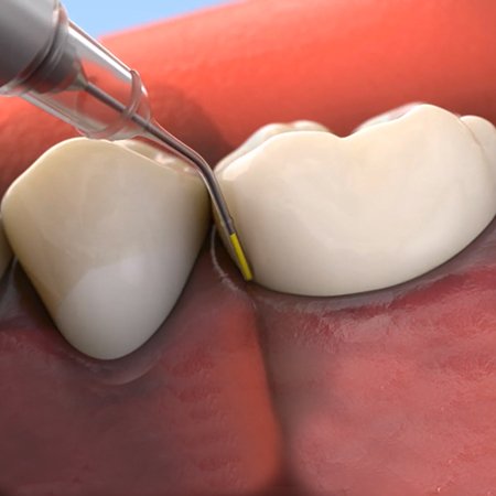 Animated smile during topical antibiotic therapy