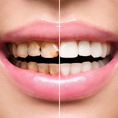 Teeth before and after full mouth reconstruction 