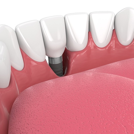 Illustration of a failed dental implant in Louisville, KY