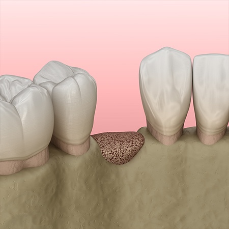 Animated smile with bone graft in place