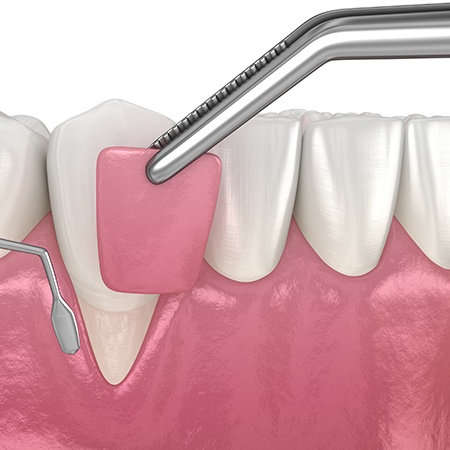 Animated smile during soft tissue grafting procedure