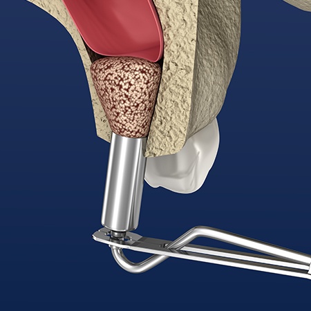 Animated smile during sinus lift procedure