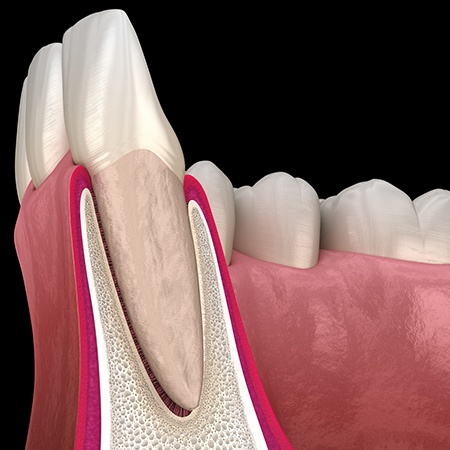 Animated smile in need of pocket reduction surgery