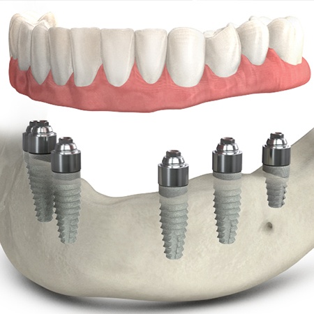 Animated TeethXpress dental implant denture placement
