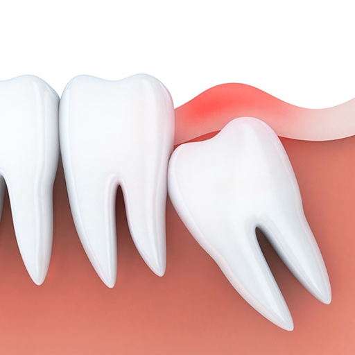 Animated smile with impacted wisdom tooth