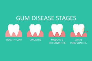Chart showing the different stages of gum disease