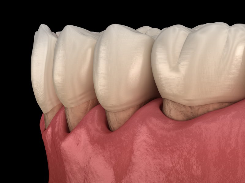 Model of teeth that have come loose due to gum disease