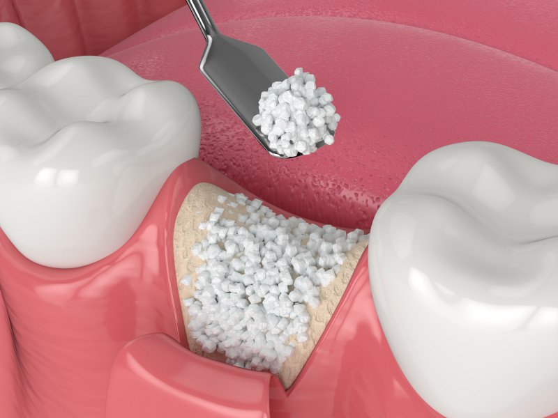 Diagram showing how a bone graft works