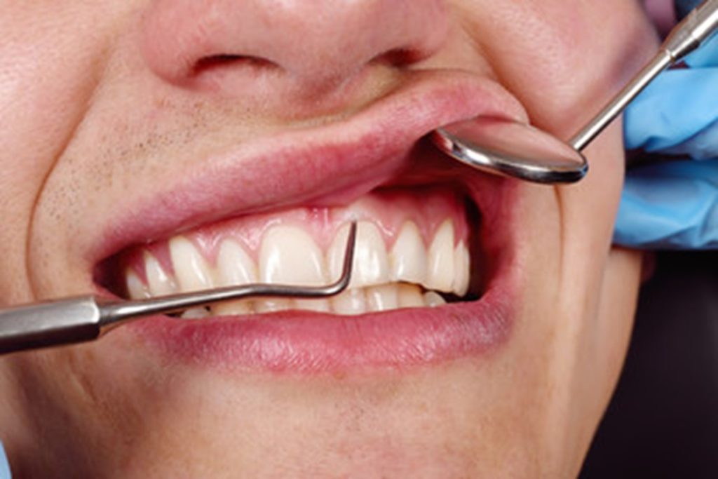 Patient having their gums inspected by the dentist for signs of gum overgrowth.