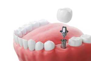 CGI of a dental implant with its crown inserted in a lower arch