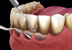 3D render of gum disease treatment