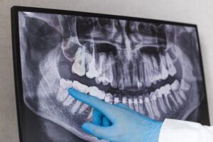 Periodontist pointing at wisdom teeth on an X-ray